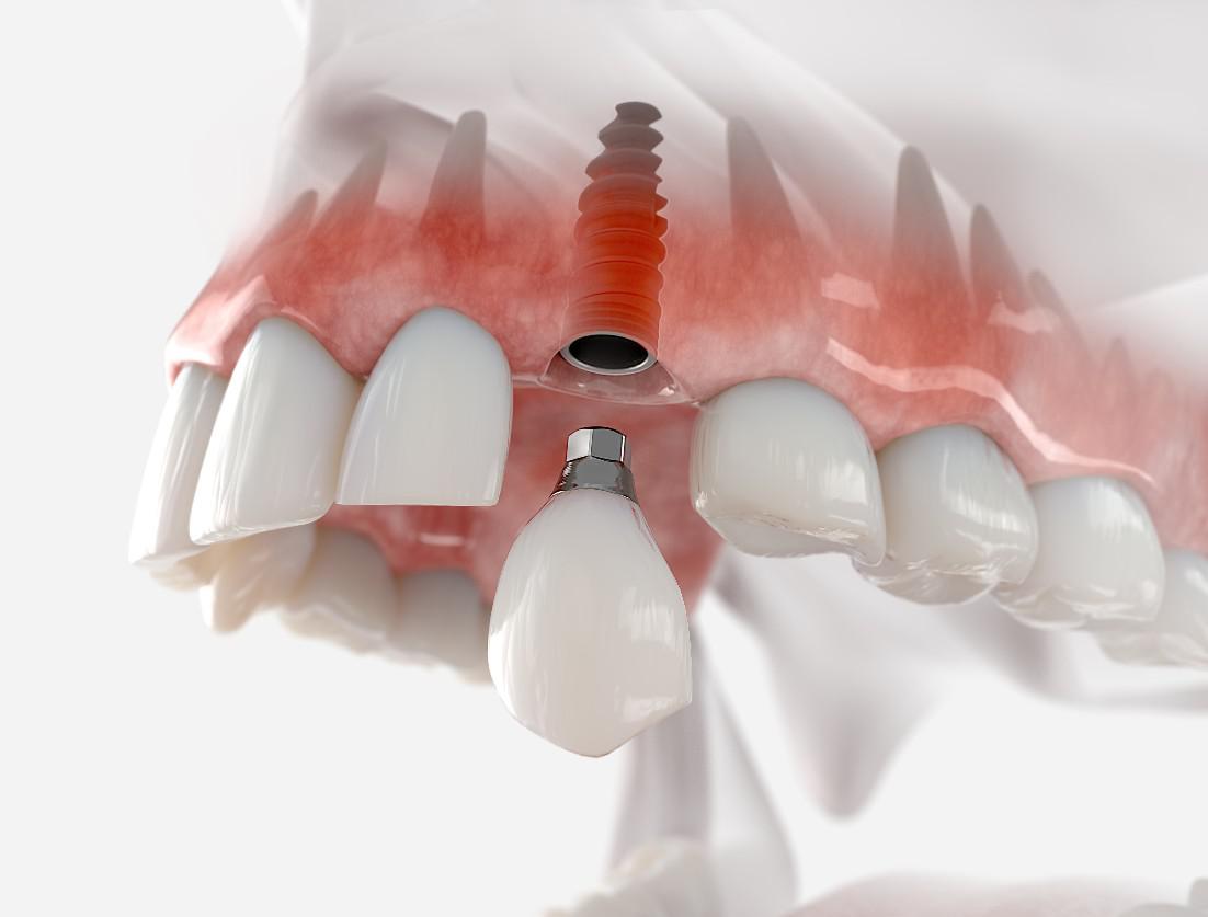 Implants vs. Dentures: Which is Right for You?
