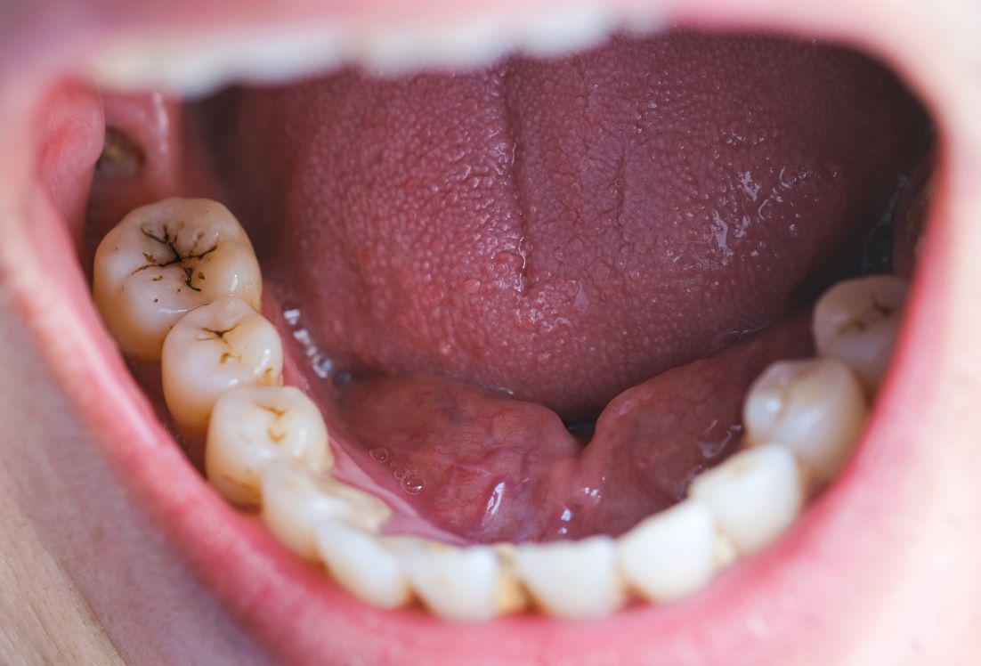 The Link Between Bad Oral Hygiene and Oral Cancer