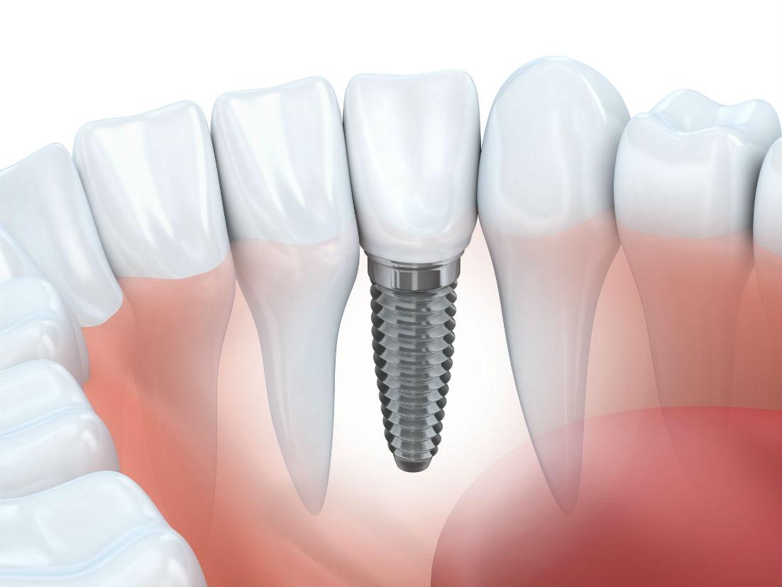 How to Avoid Common Dental Implants Problems